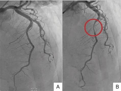 Mid-ventricular Takotsubo Cardiomyopathy With Coexisting Myocardial ...