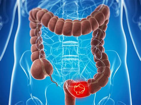 CDX2 -- New Prognostic Biomarker in Stage II Colorectal Cancer