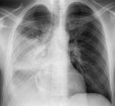 Tuberculosis Lung X Ray