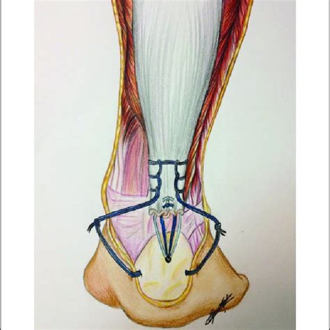 Achilles Tendon Anatomy Diagram