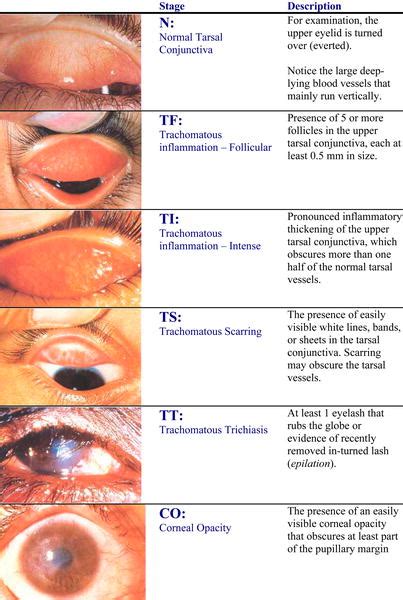 MBBS DOCTORS: Trachoma: Signs and Symptoms, Diagnosis, Treatment