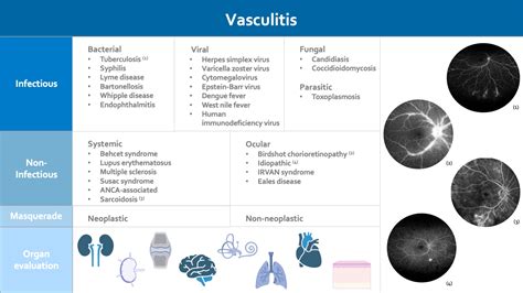 Retinal Vasculitis Eye