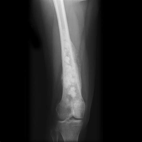 Osteosarcoma x ray - wikidoc