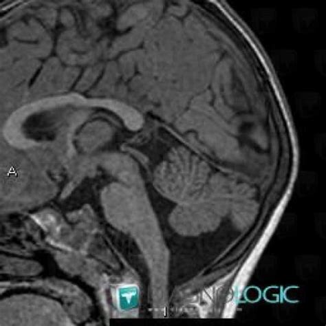 Radiology case : Mega cisterna magna (MRI) - Diagnologic