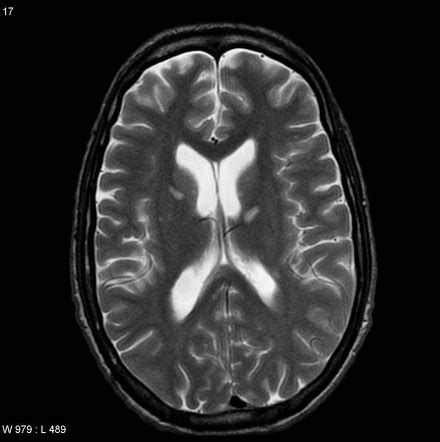 Cmv Retinitis Mri