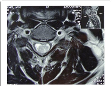 B: Preoperative Axial T2 MRI Showing solid ependymoma, which represents... | Download Scientific ...