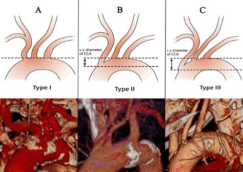 The Relation Between Aortic Arch Branching Types and the Laterality of Cardio-Embolic Stroke ...