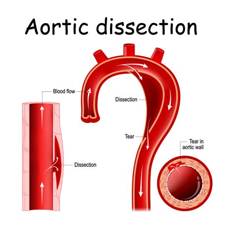 Aortic Dissection Risks and 8 Critical Symptoms | Vejthani