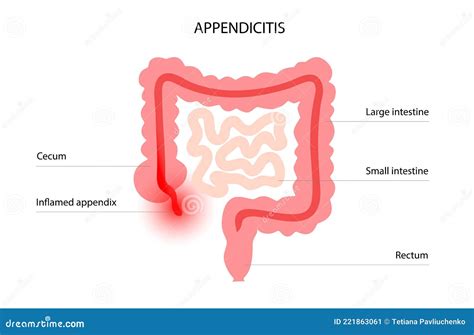 Appendix pain concept stock vector. Illustration of medicine - 221863061