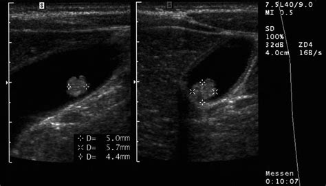 Sonographic image of the gallbladder polyp in case 2 (5×5.7×4.4 mm ...