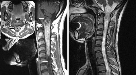 Intramedullary Spinal Cord Tumor | The Neurosurgical Atlas