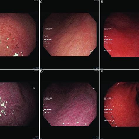 Endoscopic images of patients infected by Helicobacter pylori. (A ...