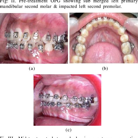 [PDF] Conservative Management of Mandibular Second Premolar Impaction ...