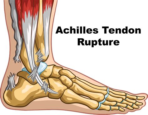 Achilles Tendon Ruptures: The Science