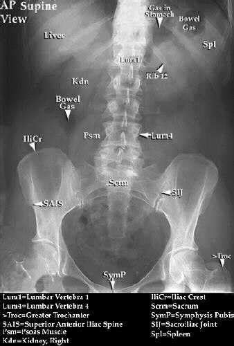 Kub X-ray labeled | What is Abdominal X-Ray or KUB? | Medical radiography, Nuclear medicine ...