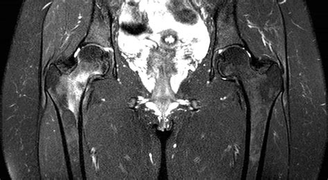 MRI showing a grade 4 A&G stress fracture of the right femoral ...