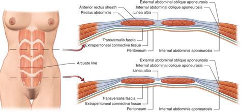 Abdominal Wall Reconstruction | Plastic Surgery Key