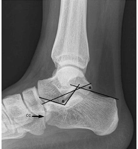 Lateral projection of the calcaneus. CC calcaneocuboïdal joint, G ...