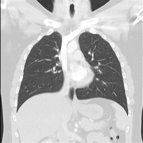 Normal Lung Ct Scan