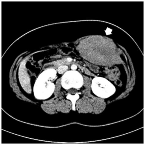 Abdominal Mri Scan Abdominal Mri Scan Showing The Tum - vrogue.co