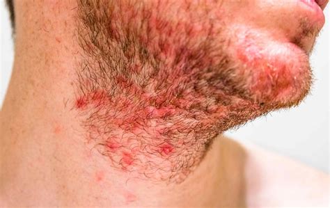 Seborrheic Dermatitis: Causes and Risk Factors