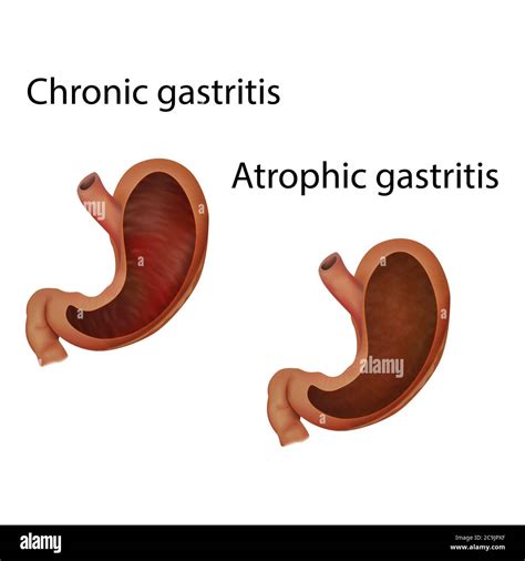 Chronic and atrophic gastritis, illustration Stock Photo - Alamy