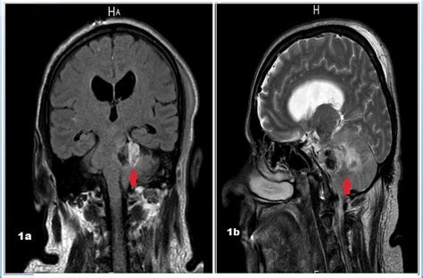 MRI showing left posterior fossa and cerebellpontine angle lesion ...