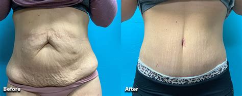 Best Tummy Tuck Oklahoma City | Bajaj Plastic Surgery