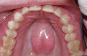 Roof of Mouth Hurts: Causes and Treatment | IYTmed.com