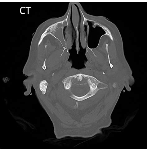 Radiology Case - Painless Enophthalmos : r/medicine