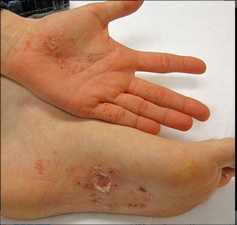 Dyshidrotic eczema (Dyshidrosis): Symptoms, Causes, Treatment and ...