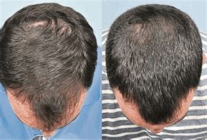 Tips to stop hair loss with Regaine | News | Dentagama