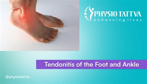 Foot & Ankle Tendonitis - Causes, Symptoms & Treatments