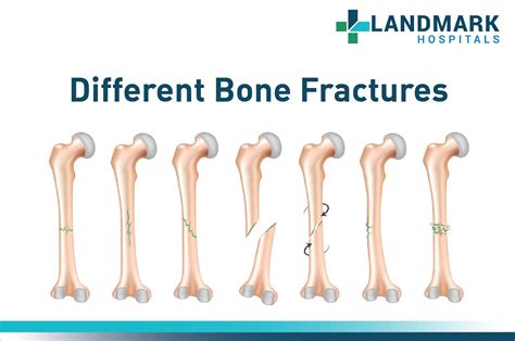 Different Bone Fractures – Orthopedic Care in Hyderabad – Landmark ...