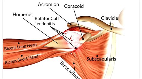 Symptoms Rotator Cuff Injury - Injury Choices