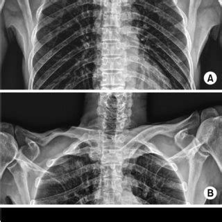 Sternoclavicular Joint Dislocation Symptoms