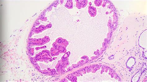 Apocrine Metaplasia Of Breast Usmle - slidesharetrick