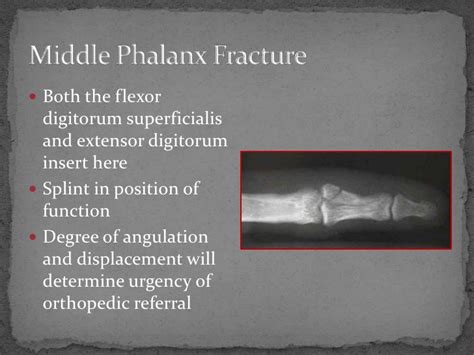 Fracture Review New Format