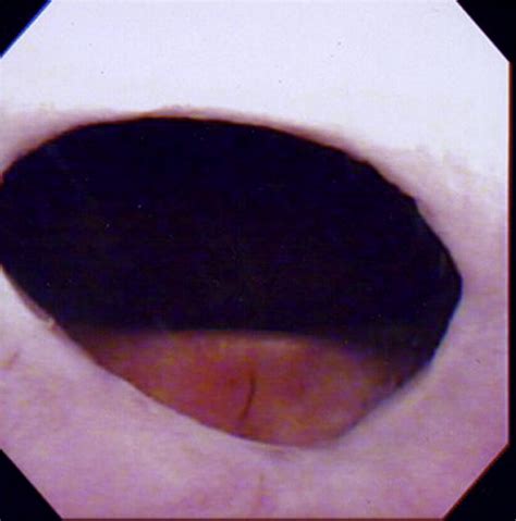 Standardized Approach for the Treatment of Refractory Bladder Neck Contractures - Urologic Clinics