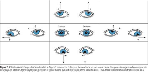 A And V Pattern Exotropia - Shajara