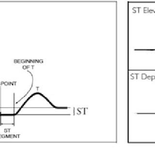 ST segment measurement [4] | Download Scientific Diagram