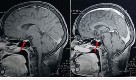 MRI of the mid-sagittal section of the brain showing partially empty ...