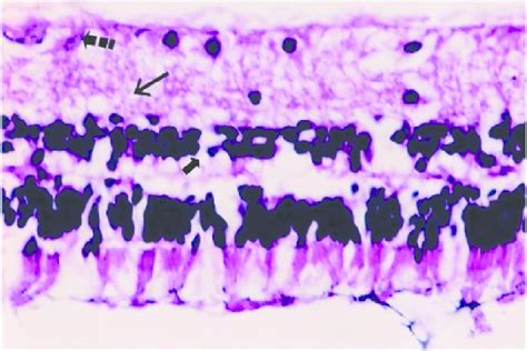 Drug: histological photograph of hydropic degeneration of a few... | Download Scientific Diagram