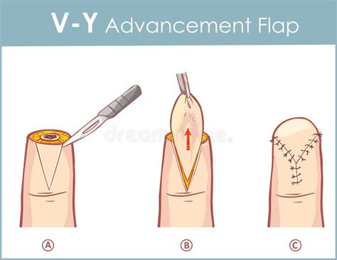 Vector Illustration of a V-Y Advancement Flap Stock Vector ...