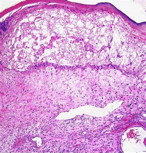 Histological variants of cutaneous Kaposi sarcoma | Diagnostic Pathology | Full Text