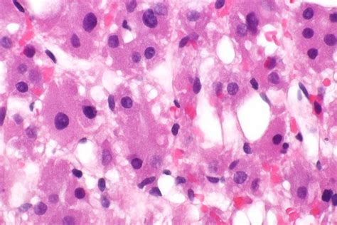 Renal tumours with eosinophilic cytoplasm - Libre Pathology