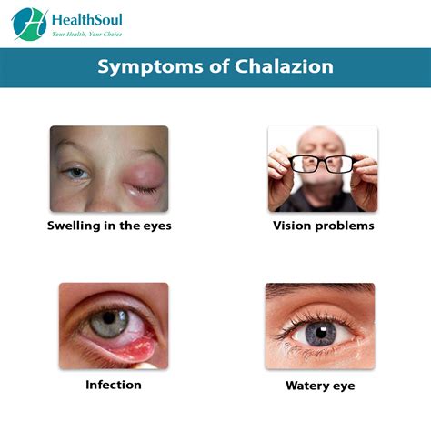 Chalazion – Healthsoul