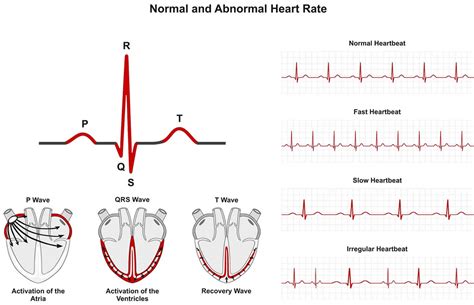 Ventricular Arrhythmia: Causes, Symptoms Treatment, 45% OFF