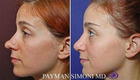 Bulbous Tip Rhinoplasty Before And After » Rhinoplasty: Cost, Pics ...