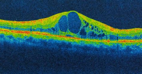 Cirugía de catarata y edema macular cistoide, entidades no ajenas entre sí - Franja Ocular